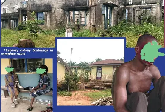 Neglected and Forgotten: The Plight of Uzuakoli Leprosy Colony Inmates
