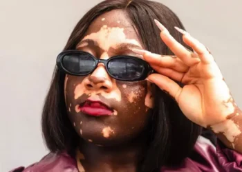 Embrace Us, We’re Just Different’: Ghanaian Vitiligo Model Abigail Boateng Speaks Out Against Stigma