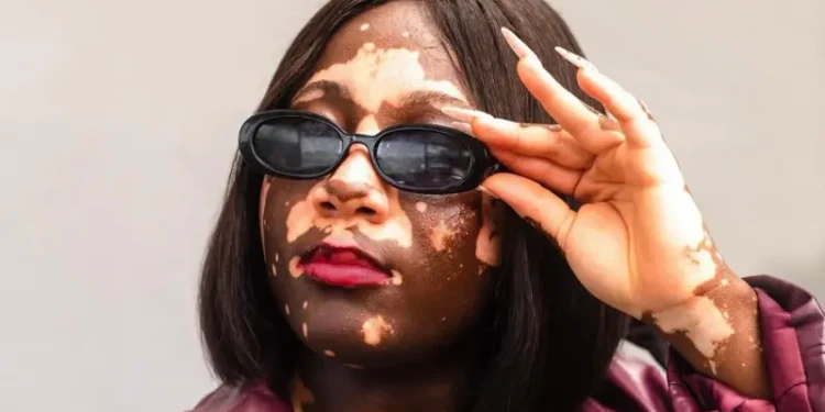Embrace Us, We’re Just Different’: Ghanaian Vitiligo Model Abigail Boateng Speaks Out Against Stigma