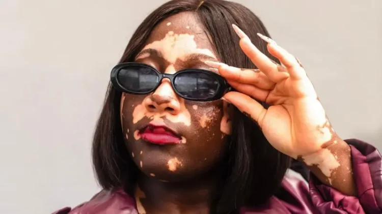 Embrace Us, We’re Just Different’: Ghanaian Vitiligo Model Abigail Boateng Speaks Out Against Stigma